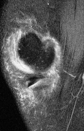 Figure 3 for case Unstable flap tear medial meniscus
